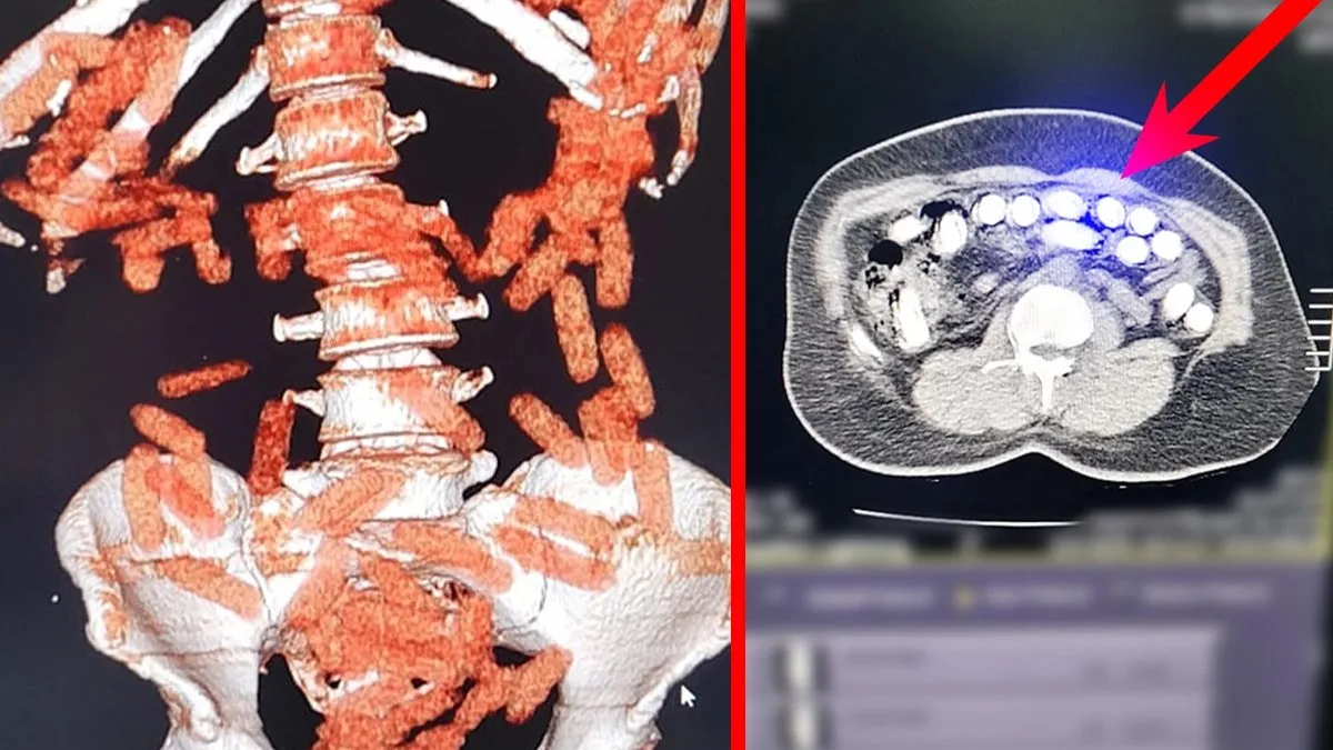 Kayseri’de düzenlenen operasyonda midesinden çıkanlar şoke etti: Tam 1 kilo!